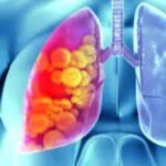 sharp rise in lung cancer among women